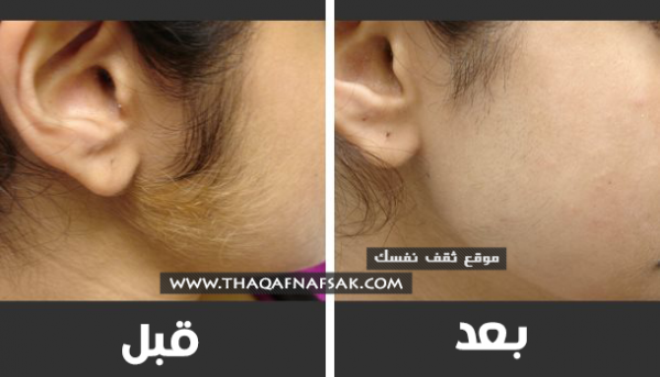إزالة شعر الوجه بوصفات تجعله لا ينمو بارز وبكثره مرة أخرى