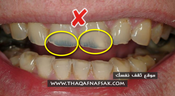 تقوية الأسنان بـ ٣١ طريقه تجعلها متينه ولا تضعف أبداً
