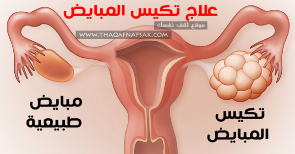 علاج تكيس المبايض بوصفات طبيعية صحية