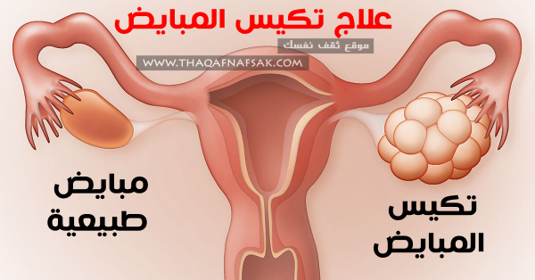 علاج تكيس المبايض بوصفات طبيعية صحية علاج تكيس المبايض بوصفات طبيعية صحية