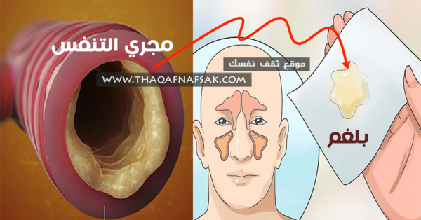 علاج البلغم بوصفات سهلة التحضير علاج البلغم بوصفات سهلة التحضير