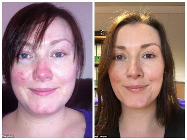 المياه المعدنية التي شُفيت امرأة مريضة بمرض الوردية ( Rosacea ) ( المياه المعدنية الشافية ) المياه المعدنية التي شُفيت امرأة مريضة بمرض الوردية ( Rosacea ) ( المياه المعدنية الشافية )