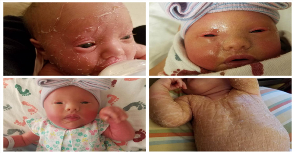 ام تغسل طفلتها ذات العام بالكلور بسبب بشرتها المماثله لجلد الثعبان : الاطباء اوصو بهذا !