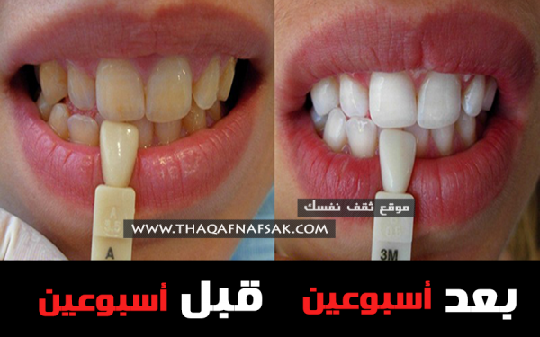 تبييض الأسنان بـ ١٥ وصفه مفعولها بعد أسبوعين تبييض الأسنان بـ ١٥ وصفه مفعولها بعد أسبوعين