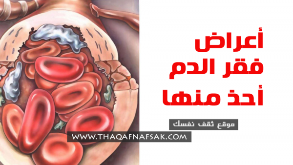 ما هي أعراض فقر الدم