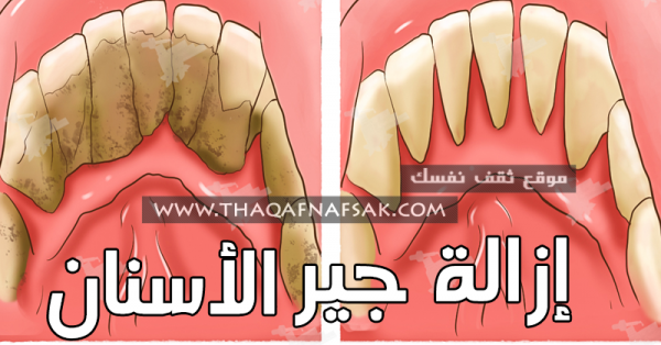 إزالة جير الأسنان ٢٤ طريقه نتائجها خلال ٣ أيام