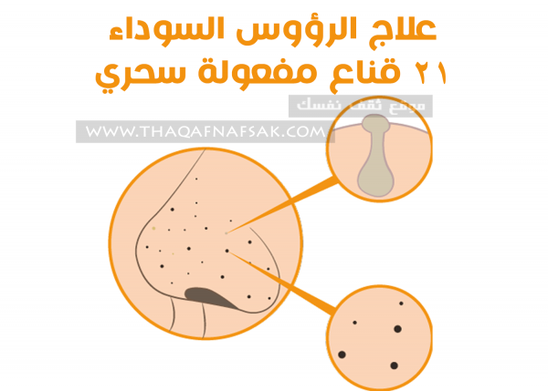 علاج الرؤوس السوداء ٢١ قناع ننصحك به علاج الرؤوس السوداء ٢١ قناع ننصحك به