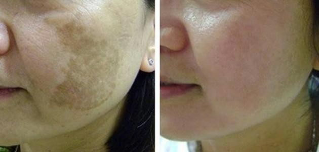 خلطة تزيل الكلف