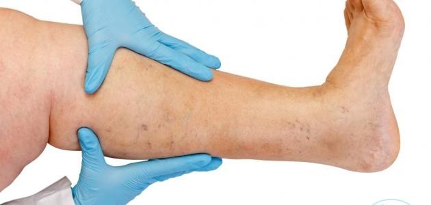 علاج سمنة الساقين علاج سمنة الساقين
