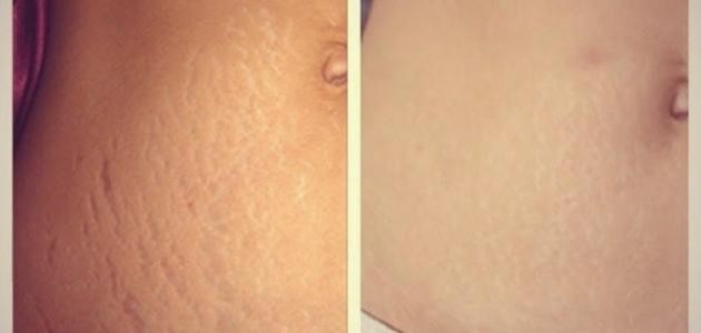 كيفية التخلص من تشققات البطن بعد الولادة