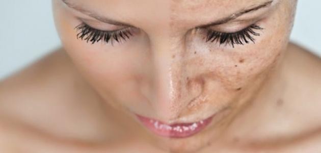 وصفة لإزالة كلف الحمل