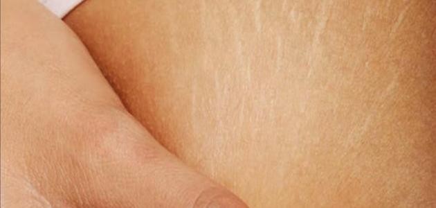 التخلص من تشققات البطن