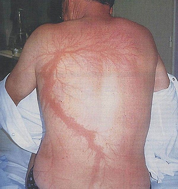 ماذا لو: تلقى جسدك صاعقة برق مباشرة؟! ماذا لو: تلقى جسدك صاعقة برق مباشرة؟!