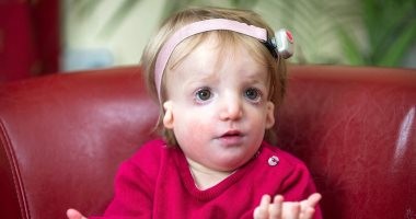 متلازمة ادوارد