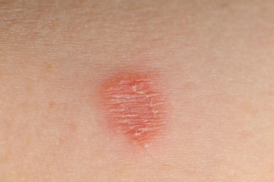 امراض الجلد الفطرية