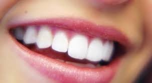 اسباب اصفرار الاسنان اسباب اصفرار الاسنان
