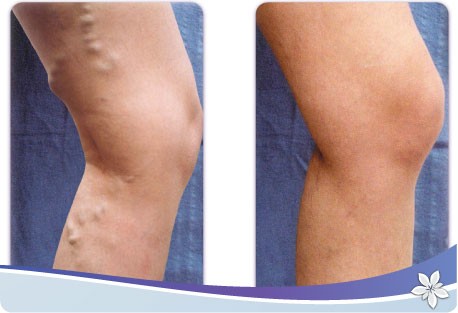 اسباب الدوالي وعلاجها