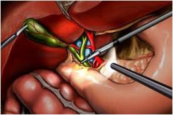 اعراض وعلاج التهاب البنكرياس