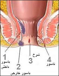 اعراض و اسباب وعلاج البواسير اعراض و اسباب وعلاج البواسير