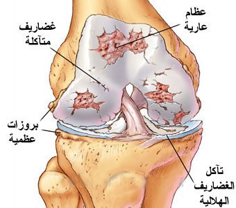 اعراض و علاج خشونة الركبة اعراض و علاج خشونة الركبة