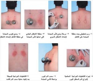 فوائد الحجامة ودواعي استعمالها