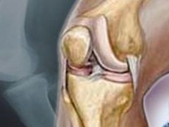 اسباب واعراض وعلاج التهاب المفاصل الروماتويدي اسباب واعراض وعلاج التهاب المفاصل الروماتويدي