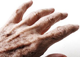 مرض الشلل الرعاش…باركنسون مرض الشلل الرعاش…باركنسون