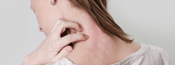 هل الأكزيما مرض وراثي ؟.. وأبرز العوامل المؤثرة لحدوثها