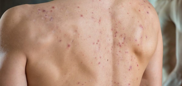 كيفية القضاء على حبوب وبثور الظهر