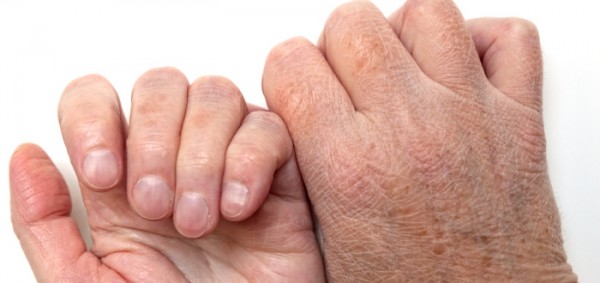 كيفية التعامل مع الجلد المتشقق والنزيف الناتج عنه