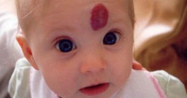 ما هي الوحمة الدموية وكيف يبدو شكلها