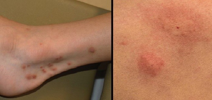 الفرق بين قرصة الناموس والبرغوث