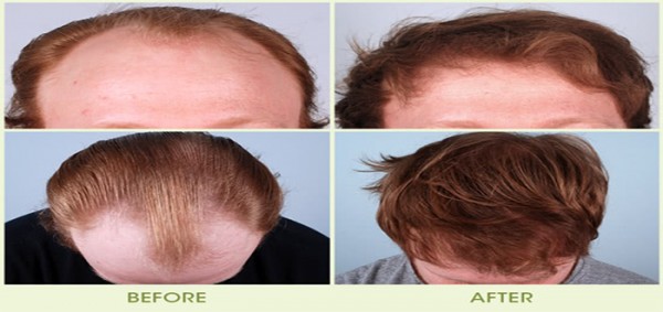 أحدث طرق زراعة الشعر بدون جراحة