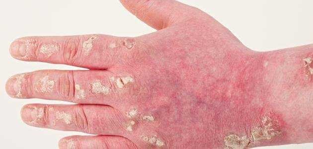 ما هي مهيجات الصدفية