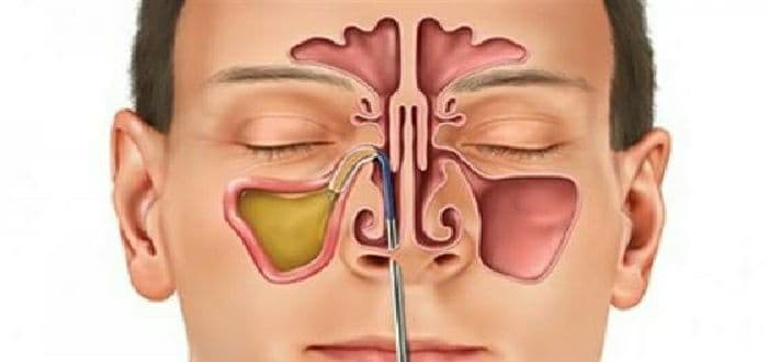 مثيرات حساسية الجيوب الأنفية