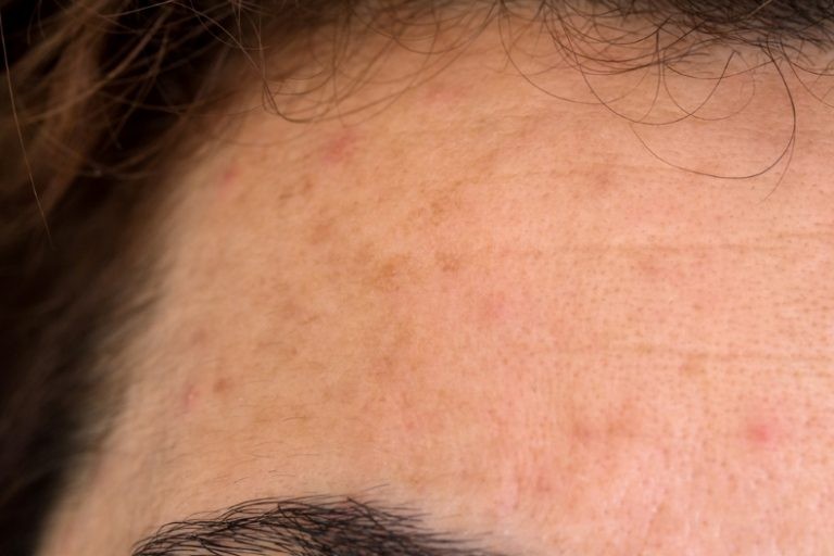 ما هو الفيتامين المسؤول عن تصبغات الجلد