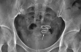 انواع اللولب بالتفصيل