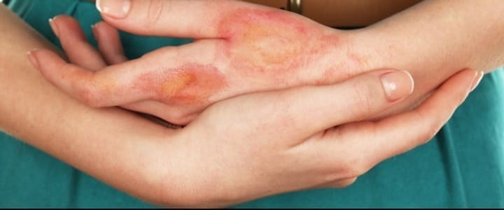 هل يعود لون الجلد بعد الحرق