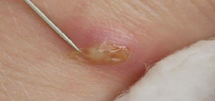 أنواع الخراج في الجسم