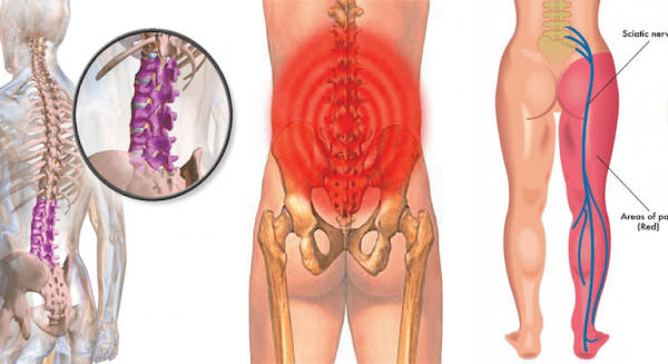 اين يقع عرق النسا