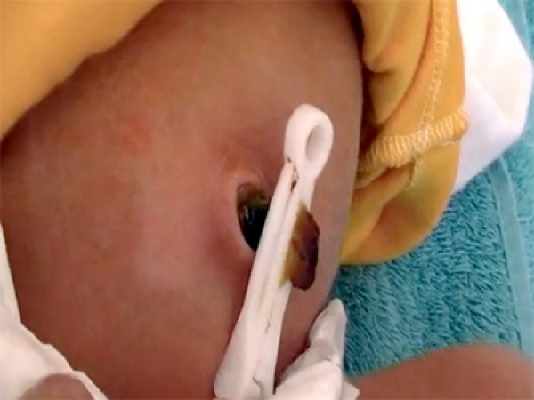 مراحل سقوط سرة الطفل