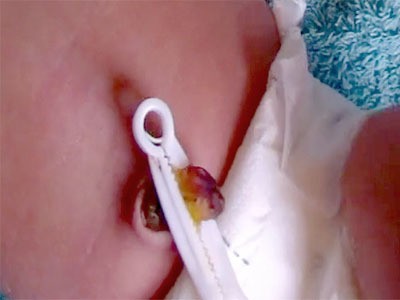 مراحل سقوط سرة الطفل