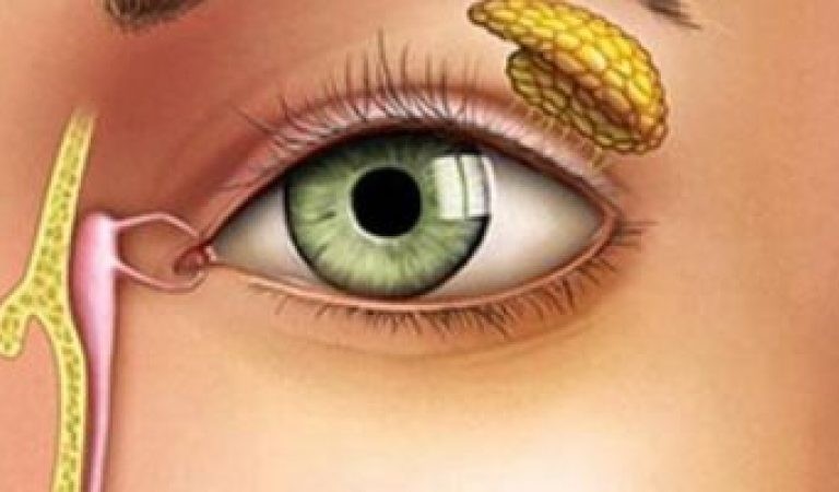 تمارين انسداد القناة الدمعية