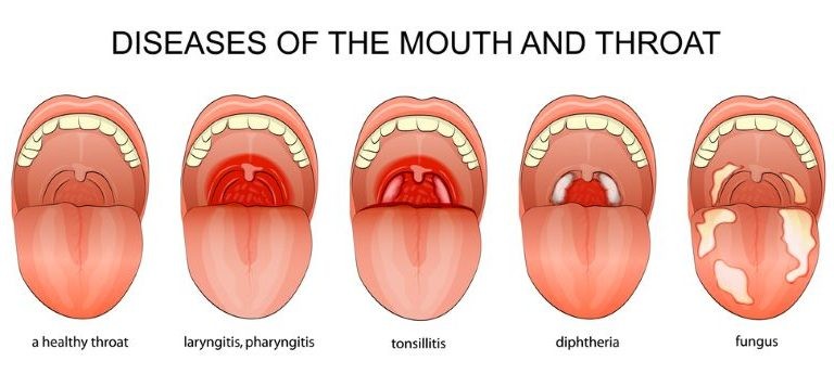 التهاب الحلق بدون حرارة