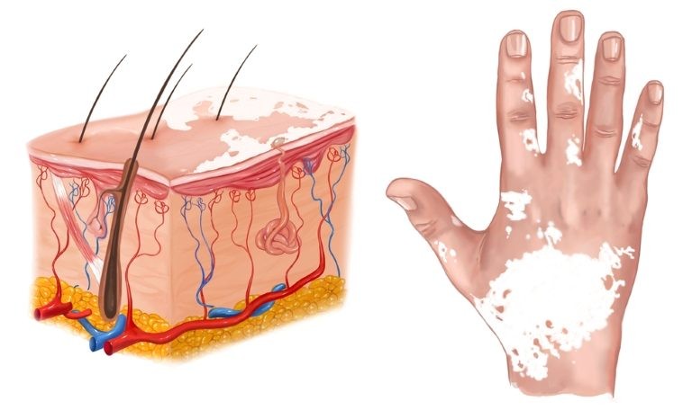 اسباب نقص صبغة الميلانين وعلاجها