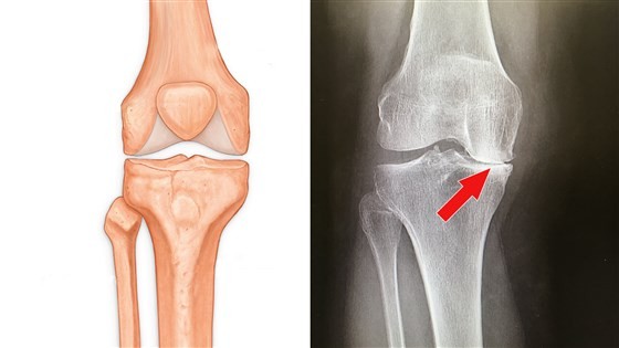 هل طقطقة الركبة خطيرة