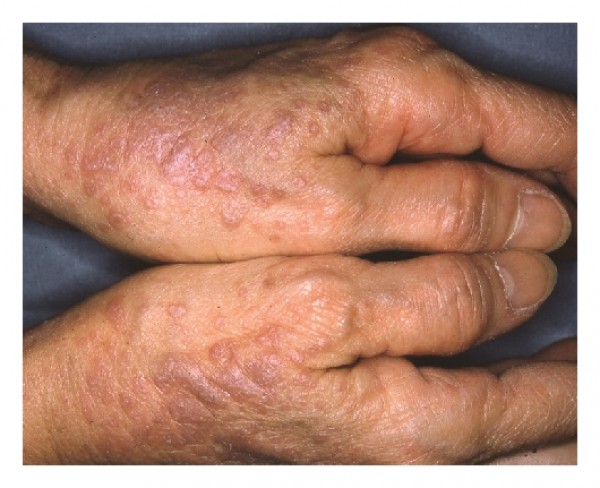 مرض الحزاز وانواعه بالصور