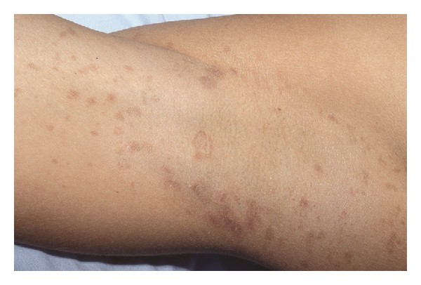 مرض الحزاز وانواعه بالصور