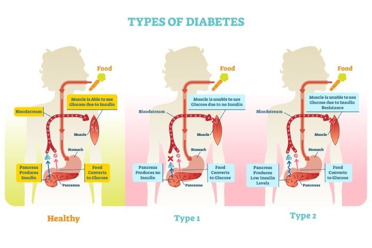 ما انواع داء السكري