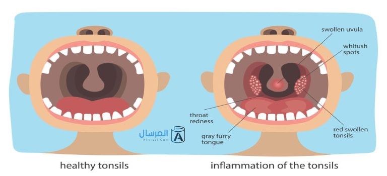 تأثير التهاب اللوزتين على الجسم
